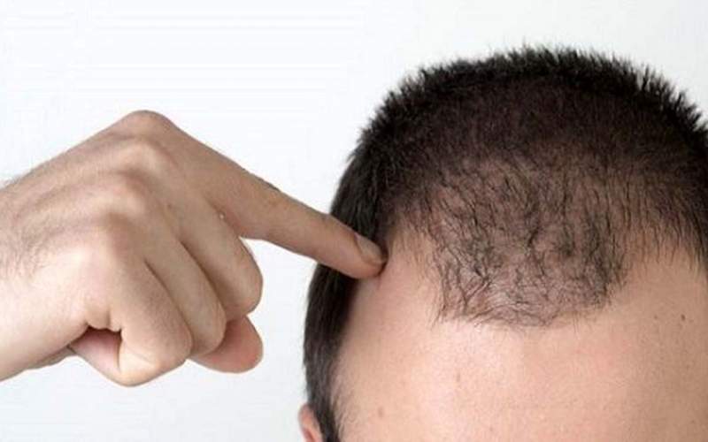 علت ریزش مو در افراد مبتلا به کرونا