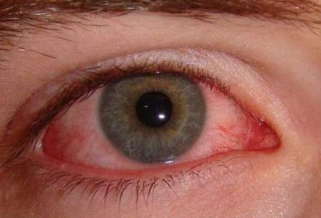 ۵ درمان خانگی برای درمان چشم متورم