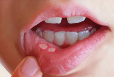 تاثیر یک پروتئین بر آفت دهان