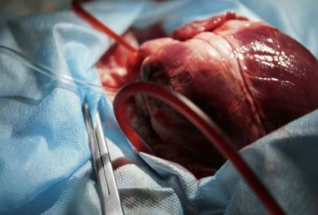 ۶کودک با روش نوین پیوندصاحب قلب جدیدشدند