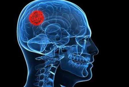 هجوم تومورهای سرطانی سایرنقاط بدن به مغز