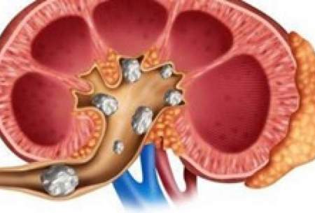 چطور سنگ کلیه نگیریم؟
