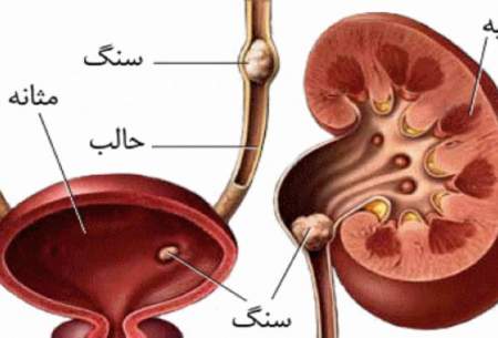 توصیه‌هایی برای پیشگیری از بروز سنگ کلیه