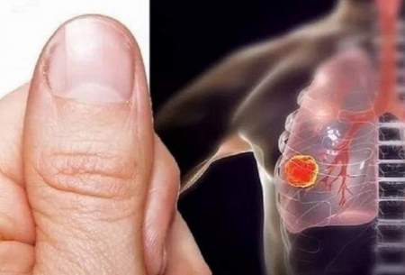 تغییر شکل انگشتان نشانه‌ای از یک بیماری مهلک