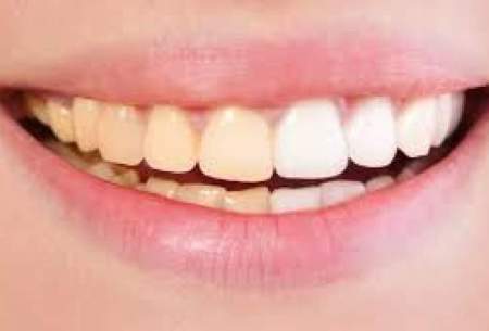 این عادت‌های غلط دندان‌های شما را زرد می‌کند