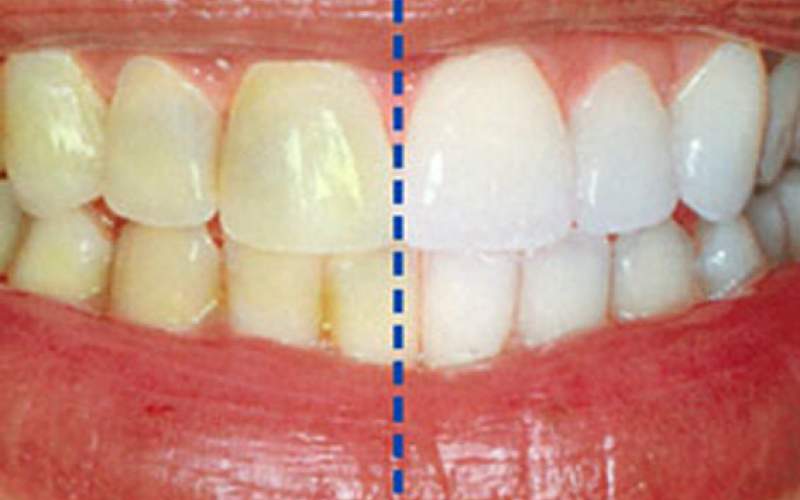 علت تغییر رنگ دندان ها چیست؟
