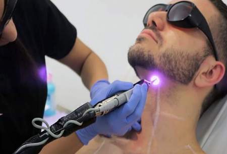 تکثیر سلول‌های بنیادی مو با استفاده از لیزر