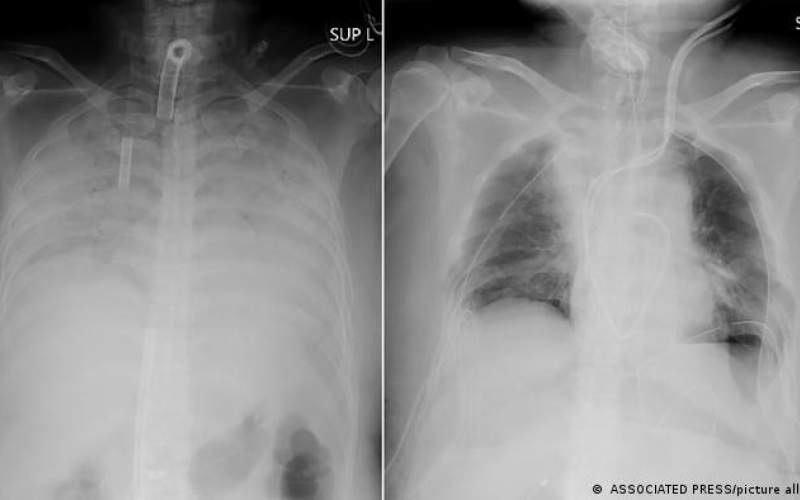 ریه این بیمار: قبل (چپ) و بعد از جراحی