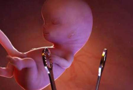 سقط درمانی جنین ناقص‌الخلقه اجباری نیست