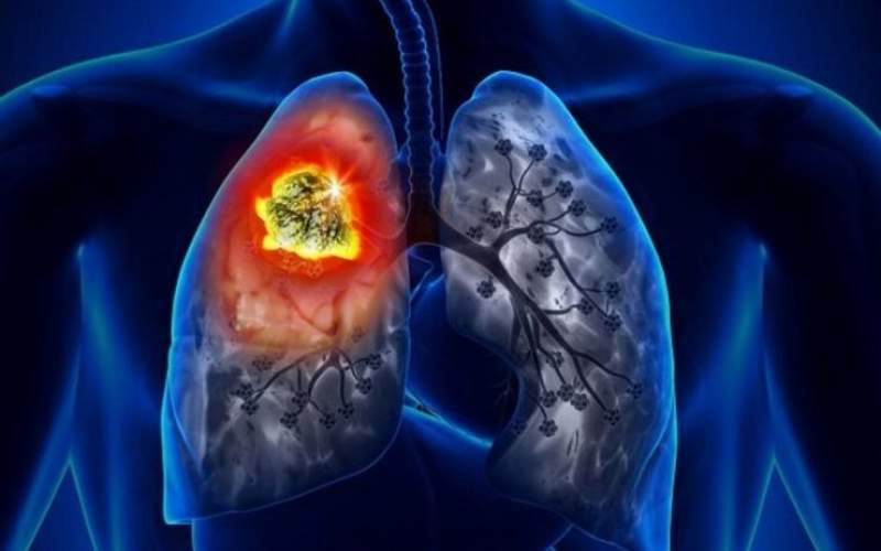 علائم عجیب سرطان ریه را بشناسید