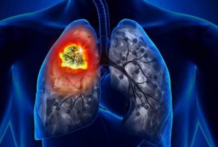 علائم عجیب سرطان ریه را بشناسید