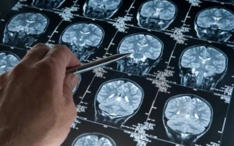 تشخیص آلزایمر با استفاده از هوش مصنوعی