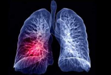 سلول‌های سرطان ریه، با کبد چه می کنند؟