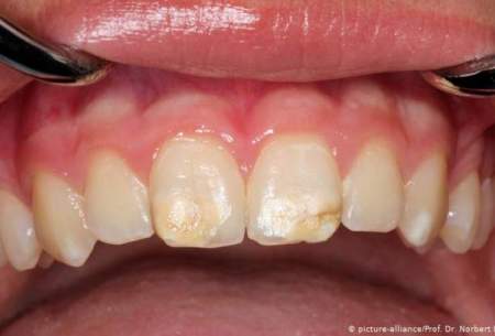 رابطه از دست‌دادن دندان‌ها و زوال عقل
