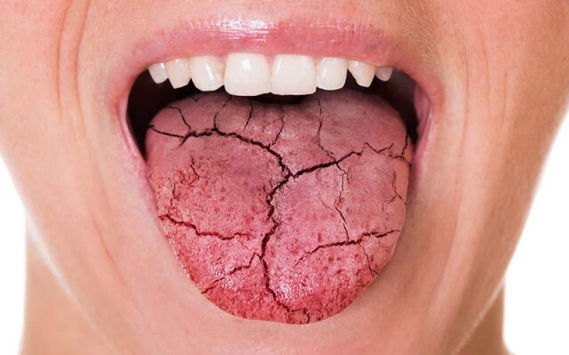 تاثیر میزان قند خون در ایجاد خشکی دهان