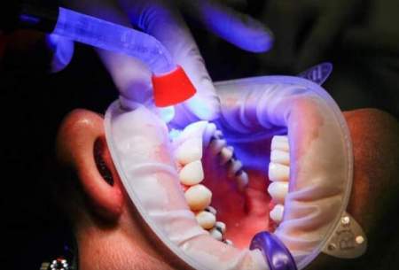 بیماری‌های شایع دندان و راه‌های مقابله با آن