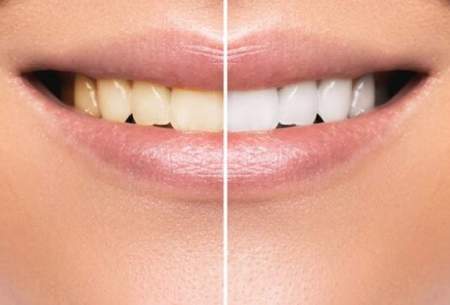 تاثیر مخرب محصولات سفید کننده بر دندان‌ها
