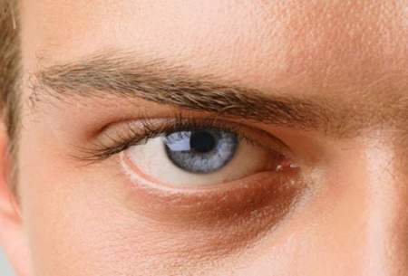 بیماری آب سیاه چشم چیست؟
