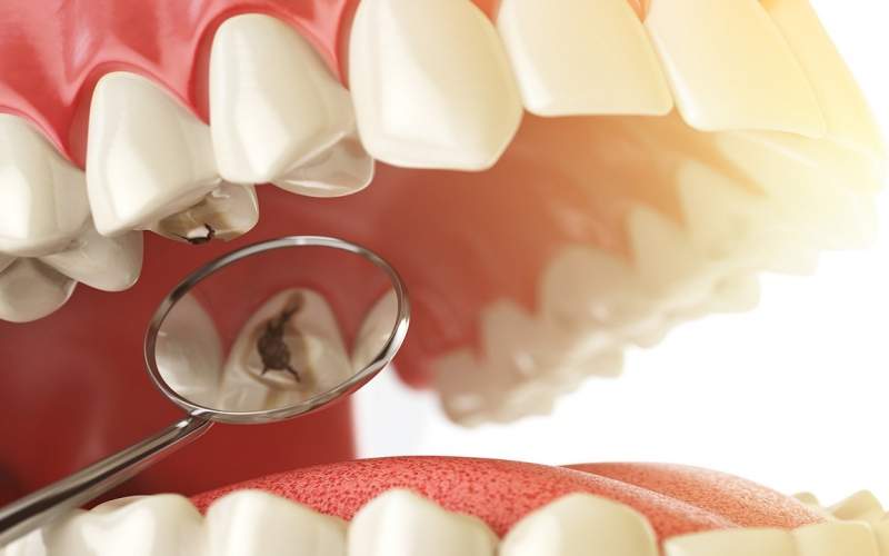 چطور دچار پوسیدگی دندان می‌شویم؟