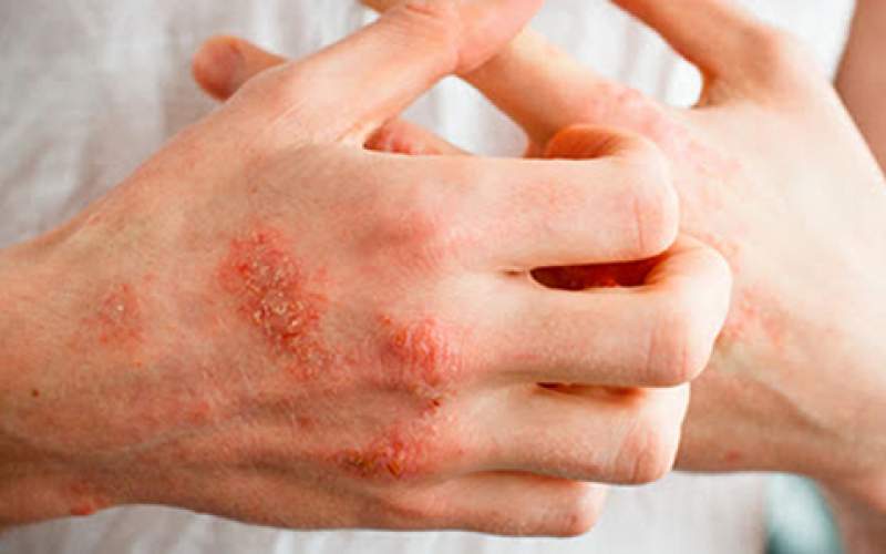 اگزمای پوستی چیست؟ علائم و راه‌های درمان