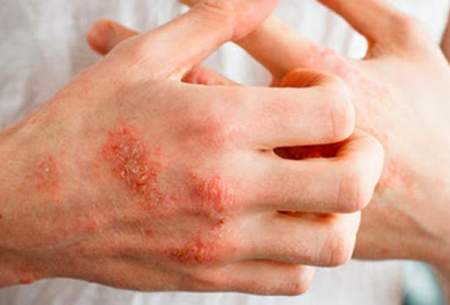 اگزمای پوستی چیست؟ علائم و راه‌های درمان