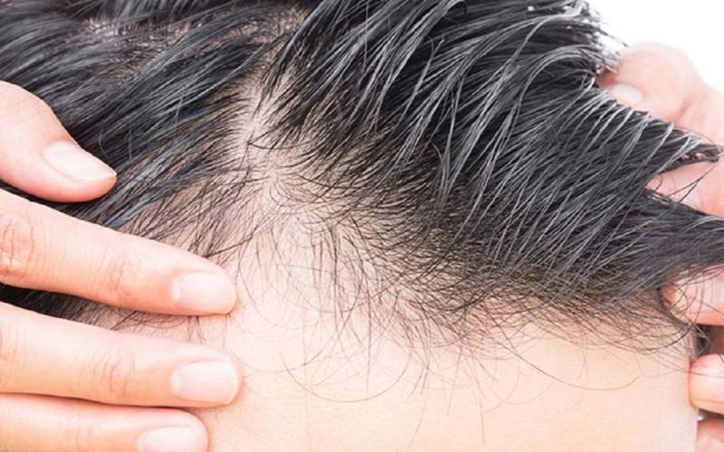 ویروس کرونا و معمای ریزش موی سر