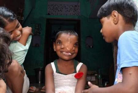 دختر هندی با دو بینی مورد احترام قرار گرفت
