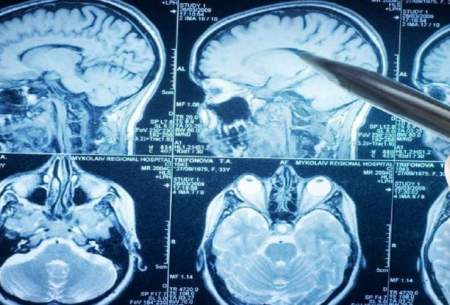 درمان مرگبارترین تومور‌ مغزی با چند راهکار ساده