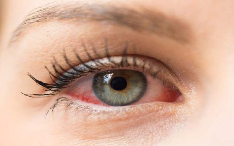 درمان بیماری خشکی چشم با استفاده از یک فناوری جدید