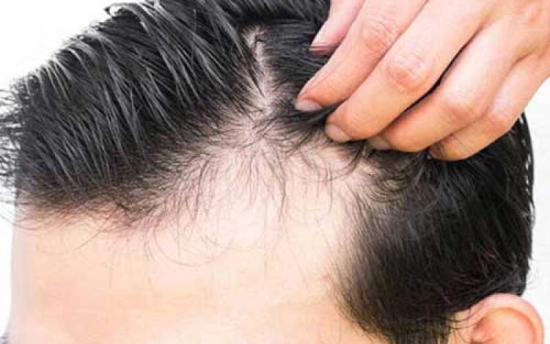 راه درمان ریزش مو پس از بیماری کرونا