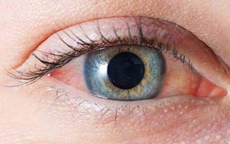 آیا سرخی چشم نشانه  ویروس کروناست؟