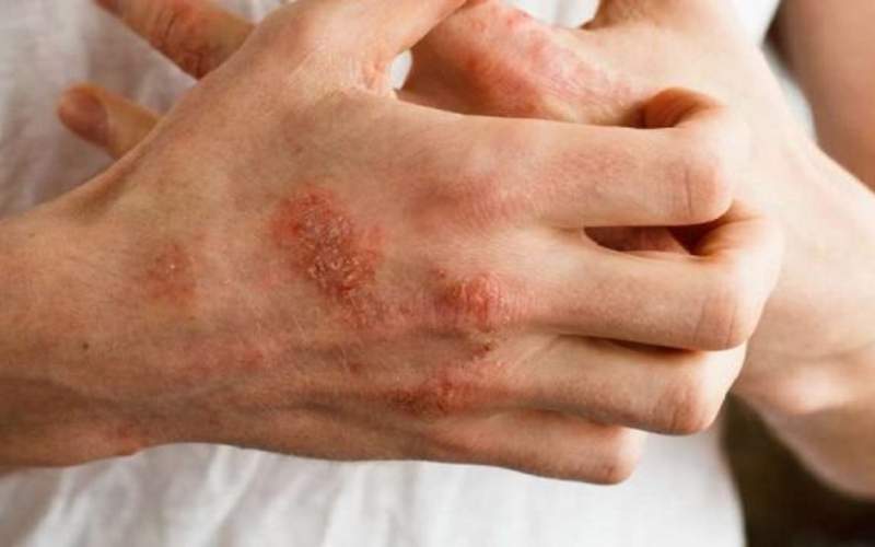 راهکار‌های طبیعی برای درمان عفونت‌ پوستی