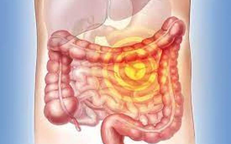 نشانه‌های سرطان روده را نادیده نگیرید