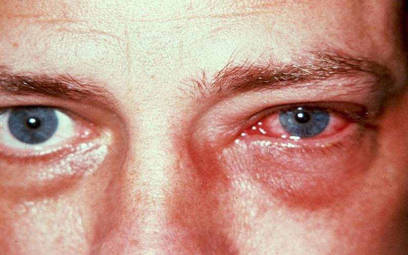 چگونه سرماخوردگی می‌تواند سلامت چشم را به خطر اندازد؟