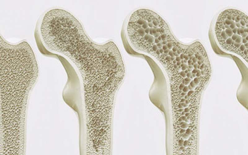 بهترین ویتامین برای پوکی استخوان
