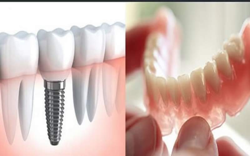 ایمپلنت یا دندان مصنوعی؟ کدام گزینه مناسب شماست؟