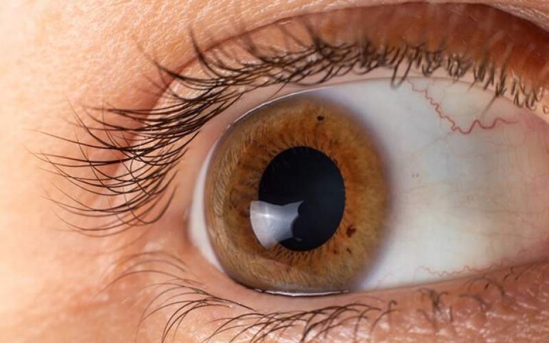ژنی که کلید درمان یک بیماری نادر چشمی است