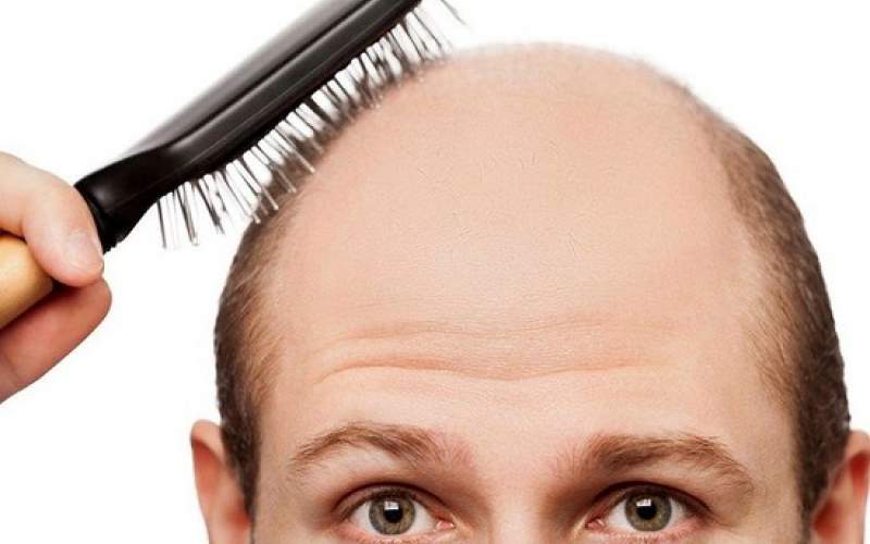 درمان خانگی ریزش مو با ۴ روغن