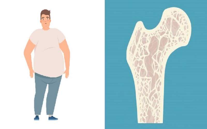 مردان چاق در معرض خطر ابتلا به پوکی استخوان