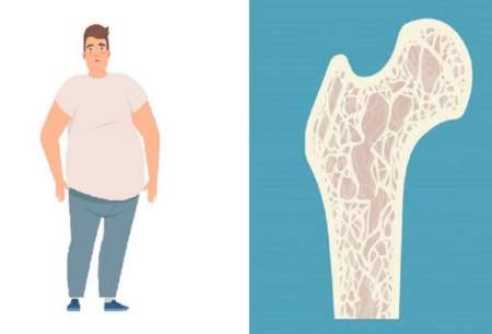 مردان چاق در معرض خطر ابتلا به پوکی استخوان