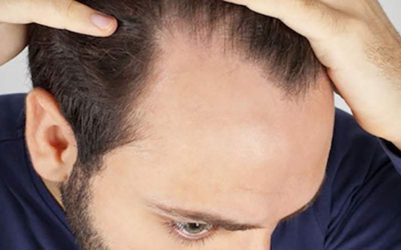 توصیه‌های تغذیه‌ای برای جلوگیری از ریزش مو