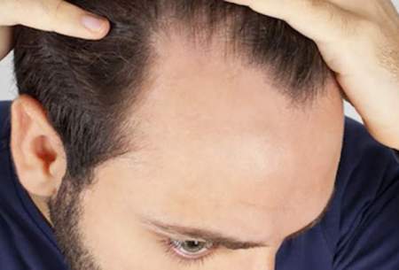 توصیه‌های تغذیه‌ای برای جلوگیری از ریزش مو