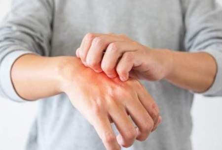 ۷ روش خانگی برای درمان عفونت پوستی
