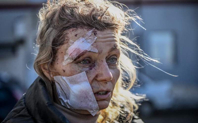 یک زن اوکراینی که در اثر بمباران‌های روس‌ها زخمی شده است