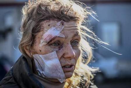 یک زن اوکراینی که در اثر بمباران‌های روس‌ها زخمی شده است