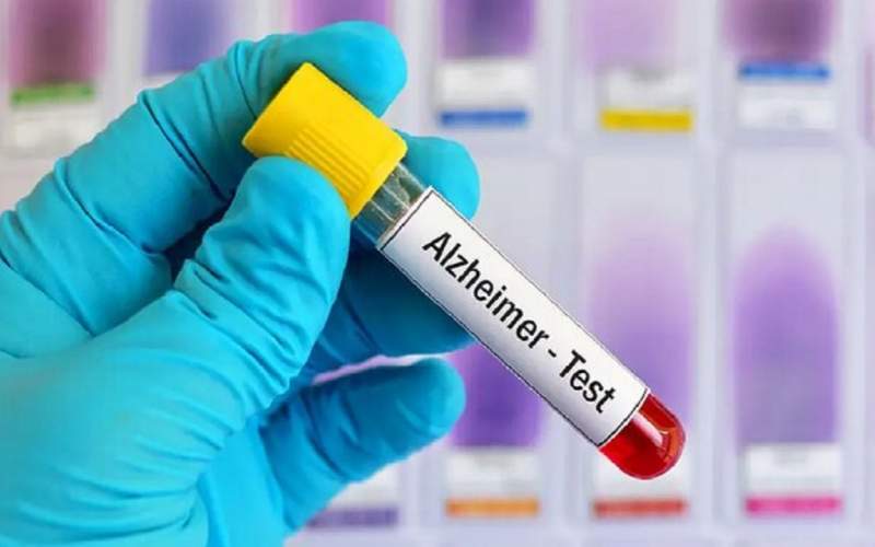 تشخیص آلزایمر از طریق نوعی آزمایش خون