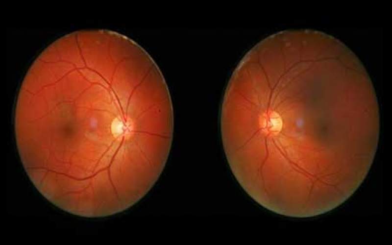 درمان انحطاط شبکیه چشم با داروی ضد اعتیاد