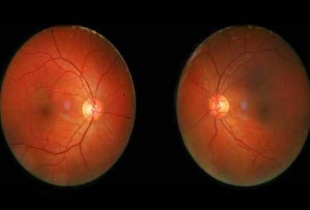 درمان انحطاط شبکیه چشم با داروی ضد اعتیاد