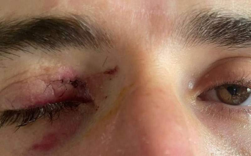 تصویر چشم زخمی انصاری‌فرد پس از جشن تولد