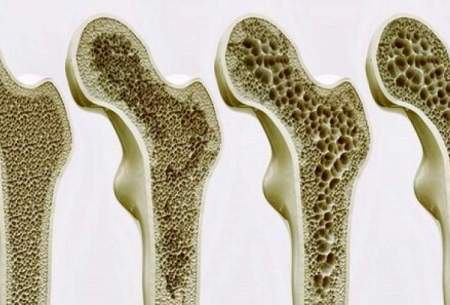 جایگزینی دیگر برای درمان دارویی پوکی استخوان
